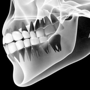 bone grafts sinus lifts